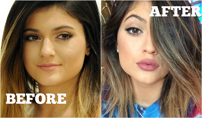 Ustnice Kylie Jenner prej in potem